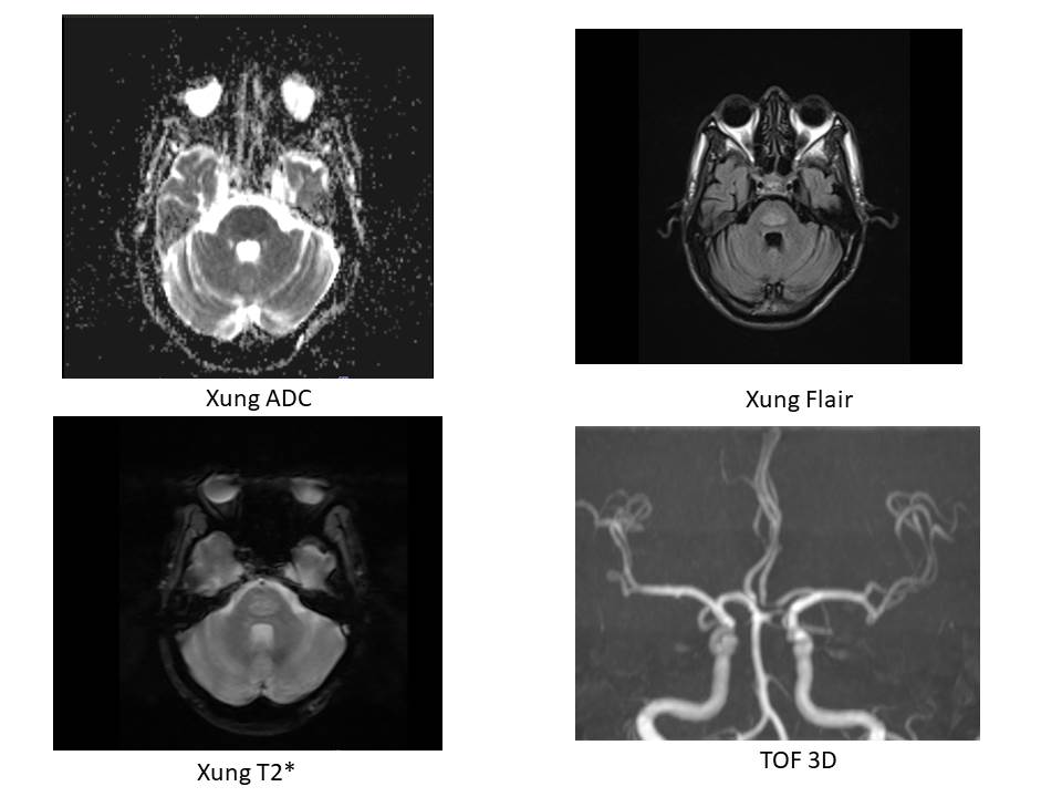 Hội chứng hủy myelin do thẩm thấu (ODS)