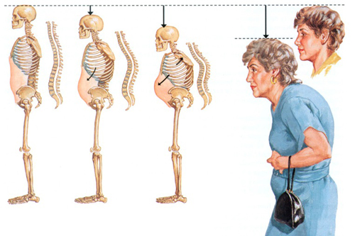 Loãng xương ở người già làm sao để phòng ngừa?