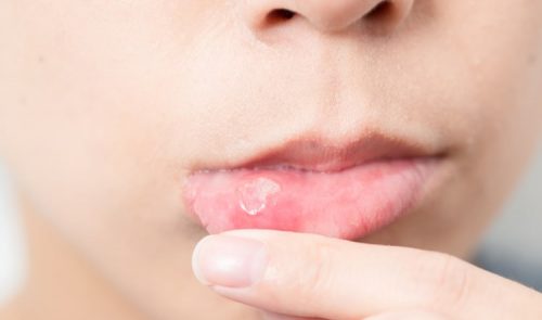 Nguyên nhân gây ra các vết loét nhiệt trong miệng