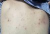 Thủy đậu ở trẻ em: Phòng tránh và bí quyết chăm sóc hiệu quả
