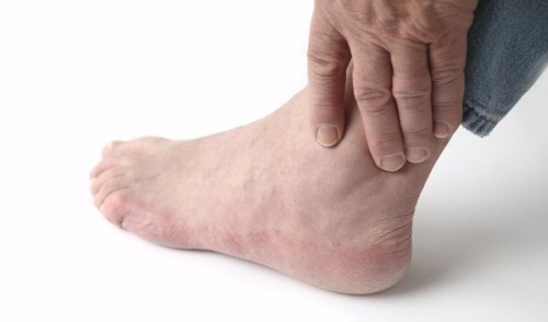 Lưu ý giúp điều trị bệnh gout đạt hiệu quả tốt nhất